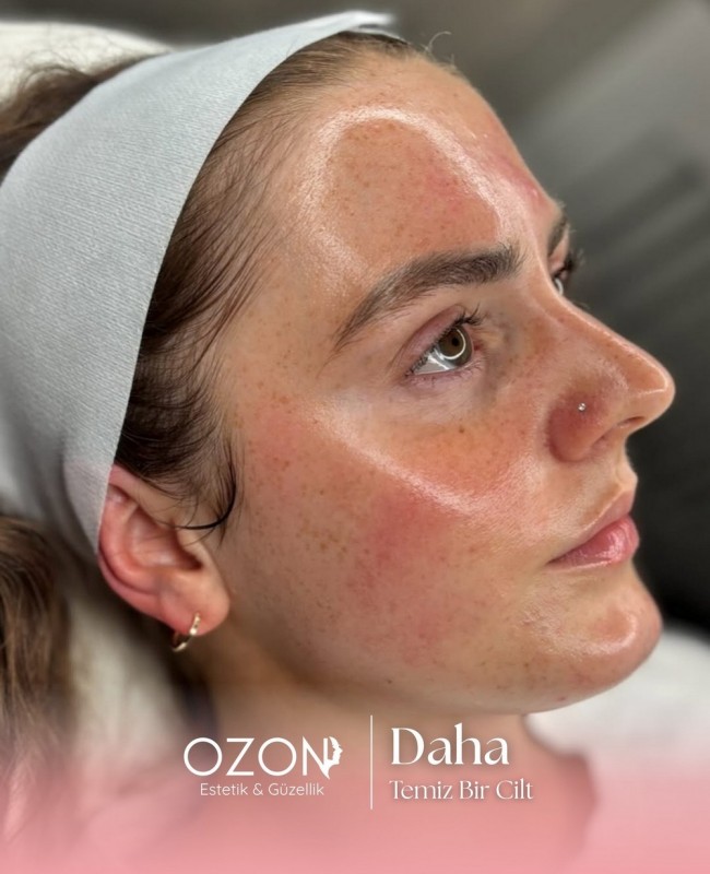 Ozon Estetik | Ankara Güzellik ve Estetik Merkezi