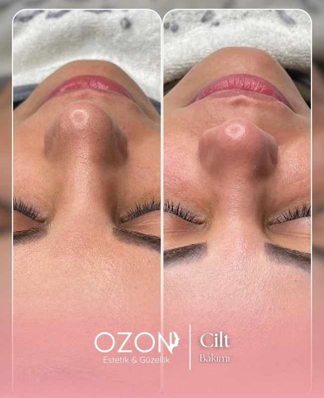 Ozon Estetik | Ankara Güzellik ve Estetik Merkezi