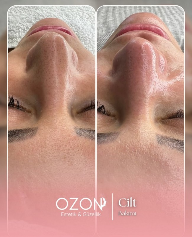 Ozon Estetik | Ankara Güzellik ve Estetik Merkezi